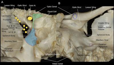 Simultaneous Endoscopic Endonasal Decompression of the Optic Canal, Superior Orbital Fissure, and Proper Orbital Apex for Traumatic Orbital Apex Syndrome: Surgical Anatomy and Technical Note